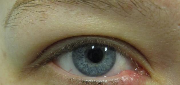 كيف يمكن علاج الكيس الدهني في العين؟